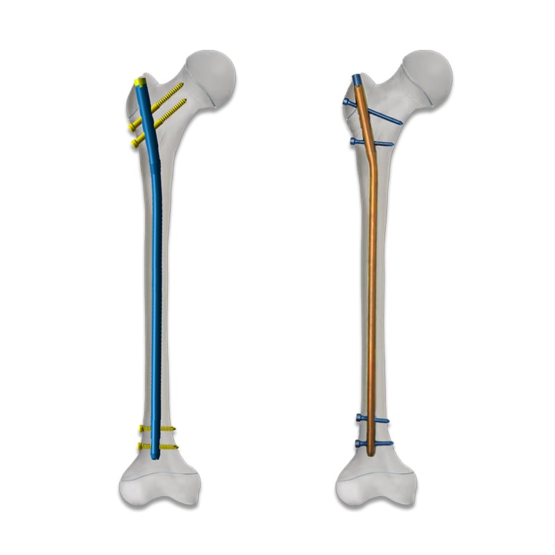 Pediatric Femoral Interlocking Nail (PFN)